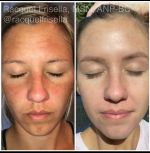 “What will I look like once I start using botox and medical grade skincare?!
.
LIKE THIS! You will look refreshed, rejuvenated, and likely younger than before you ever started! 
.
This is another gorgeous friend and client’s skin transformation over the last YEAR! Yep, just ONE year! She came to me for wedding prep skin help and now she is feeling more beautiful and confident than ever💕
.
It doesn’t happen overnight. Transforming your skin to be its very best is a slow (&fun!) process that requires consistency, commitment, and forming good skin habits….then let me work my magic 😉
.
This is a true example of what investing in your skin with consistency looks like. Being regular with skincare and injectables is the secret sauce. Here’s what we did:
✨Daily use of Medical grade @rfaskincare 
✨Preventative Botox every 3-4mos
.
Fighting the pigmentation from sun damage/melasma takes work. She practiced daily sun protection with sunscreen and shading the face with hats when possible. She followed a custom skin plan I put together for her.
✨Prime + Protect SPF + Koji-C Acid + Radiant Vit C are some of the 🔑 staples
.
I believe everyone should love the skin they are in! It never gets old when my patients share these photos but more importantly the inner glow in these photos is what really lights me up! Knowing I can help someone feel amazing inside their skin is why I love doing what I do...because I know that translates into all areas of life.
.
I focus heavily on anti-aging through injectables with Tox and Filler but I also love helping virtual clients nationwide with complimentary RFA skincare plans. I can ship my medical grade products nationwide. Link in bio ✨
.
Also in the beauty section of my blog I have LOADS of blogs covering all things botox, fillers, and skincare if you want to educate 📚
Www.RacquelFrisella.com
To book or see our services:
Www.RacquelAesthetics.com
.
#lovetheskinyouarein #happy #healthy #beautiful #nurseinjector #racquelfrisella #beauty #aesthetics #transformyourskin #investinyourself #skincare #amazing skin