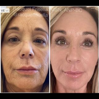 It is NEVER too late to begin taking care of your skin! The younger the better…. prevention is the key to aging gracefully. 
.
As we age we slowly use the good fat, collagen, elastin and volume in the face. As these fat pads atrophy we start to see descent of the face as wrinkles, hollows, and overall laxity sets in. The face slowly falls.
.
If we stay on top of it we can slow and reverse this process. We can use injectables to erase wrinkling and re-volumize those areas that have lost it. It will look natural and wipe years away- taking you back to natural volumized self!
.
This is another gorgeous friend and client’s skin transformation over the last THREE years! She is feeling more beautiful and confident in her 50’s than she did in her 40’s. Who says we can’t age backwards?! 💕
.
It doesn’t happen overnight. Transforming your skin to be its very best is a slow (&fun!) process that requires consistency, commitment, and forming good skin habits….then let me work my magic 😉
.
This is a true example of what investing in your skin with consistency looks like. Being regular with skincare and injectables is the secret sauce. Here’s what we did:
✨Botox/Dysport every 3-4mos between brows and in crows feet to erase wrinkles and to lift and open the eyes
✨Filler sessions every 6 months. The key is to start slow and build the foundation. We build slowly with each session to achieve our goal of a natural yet, volumized look. We treated her under eyes, lateral & malar cheeks, under eyes, folds, lips, and we built that jawline to hide any pre-jowling. 
✨We polished her skin with BBL + MOXI laser to improve texture & erase sun damage
✨Daily use of a medical grade @rfaskincare plan for the last few years. This will help her maintain results and keep her skin glowing for years to come. Medical grade skincare will continue to CHANGE her skin.
.
SKINCARE ship Nationwide/Canada : reach out for a complimentary @rfaskincare consultation! Click link in my bio to request and I’ll put a plan together just for YOU and explain just how to use it all. 
.
TREATMENT IN OFFICE for local or willing to travel: for help and my recs email my coordinator Lea@RacquelAesthetics.com