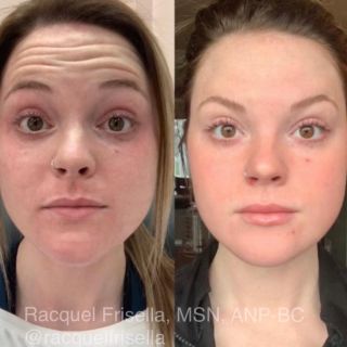 B&A a little preventative and “refresher” combination treatment with Botox, Lip filler, & Moxi Laser. This patient has also been using my medical grade skincare for about 2 years and we created a plan to help her maintain these results. 
.
This beauty made a 6 hour drive from Ohio to see us at Racquel Aesthetics! We have many patient drive or fly in for our customized treatment plans! It’s always such an honor and a privilege.
.
The earlier we begin to take care of our skin the better! We want to age gracefully and preserve our skin. It’s best to address fine lines “etching in” and volume depletion as soon as it begins.
.
This is a great treatment combo for someone just getting started and wanting to really take her skin next level with both prevention and correction.
.
Here’s what we did:
✨Botox between the brows and forehead to erase wrinkles and lift the brow
✨Very subtle lip filler to give her a little more definition in shape & volume. Also adds hydration to lips
✨Moxi laser to “polish” the skin. This laser is our new favorite because it tackles sun damage AND works on texture and resurfacing. We can even layer this on top of BBL laser for those who need more aggressive treatment. Laser performed by the amazing @aesthetics_by_emily 
✨Emily zapped her little broken blood vessels w/ our VBeam laser (you can see those 2 red spots still healing)
✨Customzied medical grade skincare plan using the highest quality  @rfaskincare this will help her really maintain and boost these in office treatments for the long haul 
.
Her work is simply undetectable. She looks just like herself. We just wiped a few years away. My approach to aesthetics is less is more. Naturally beautifully. Enhance what you’ve got girl.
.
She looks rested, revitalized, and refreshed! That’s just what we wanted!
.
SKINCARE help we ship Nationwide/Canada : reach out for a complimentary @rfaskincare consultation! You can click link in my bio to request and I’ll put a plan together just for YOU and explain just how to use it all. 
.
TREATMENT IN OFFICE options for local or willing to travel: for help and my recs please email my coordinator Lea@RacquelAesthetics.com or call my office 636-742-1122